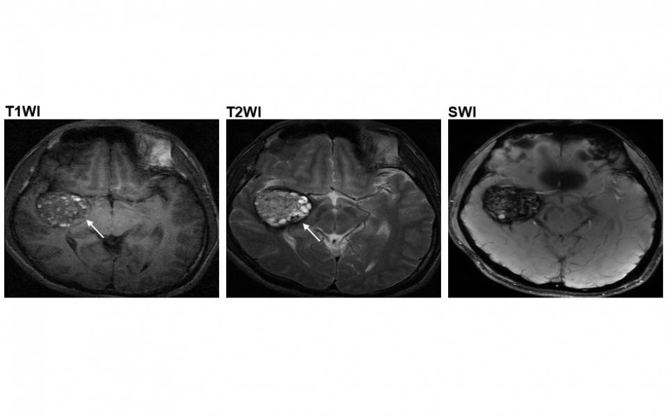 CCM二型患者于脑血管中长有爆谷形状肿瘤 (箭嘴示)